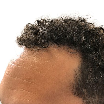 Hair Transplants Before & After Patient #3551