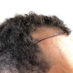 Hair Transplants Before & After Patient #3551