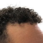 Hair Transplants Before & After Patient #3551