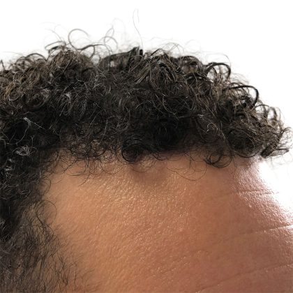 Hair Transplants Before & After Patient #3551