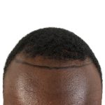 Hair Transplants Before & After Patient #3552