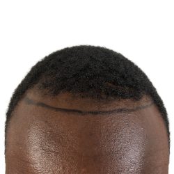 Hair Transplants Before & After Patient #3552