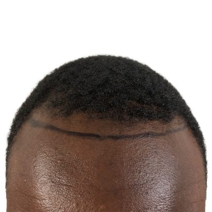 Hair Transplants Before & After Patient #3552
