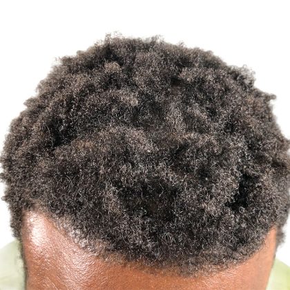 Hair Transplants Before & After Patient #3552