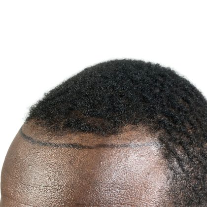 Hair Transplants Before & After Patient #3552