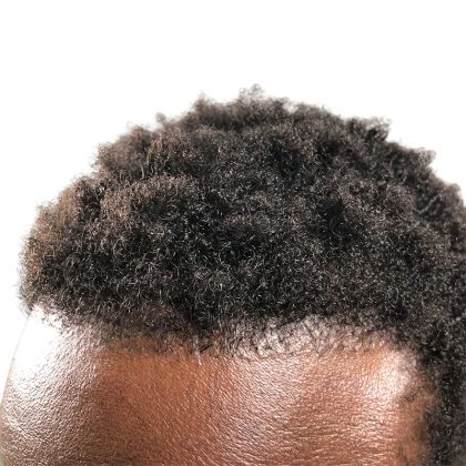 Hair Transplants Before & After Patient #3552