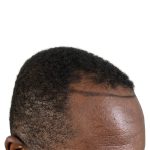 Hair Transplants Before & After Patient #3552