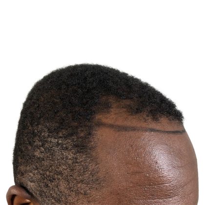 Hair Transplants Before & After Patient #3552