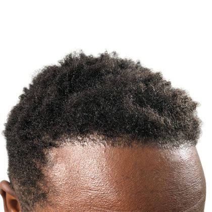 Hair Transplants Before & After Patient #3552