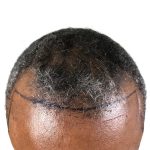 Hair Transplants Before & After Patient #3553