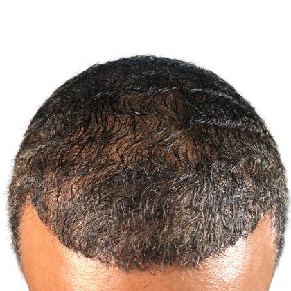 Hair Transplants Before & After Patient #3553