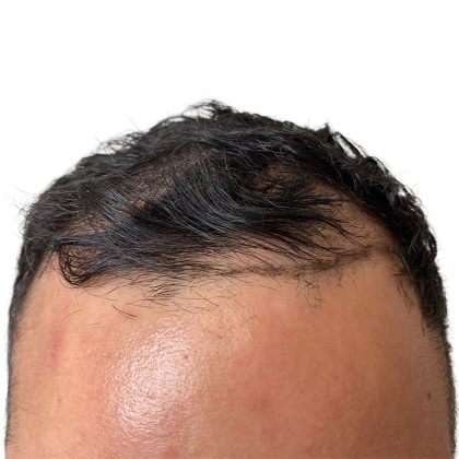 Hair Transplants Before & After Patient #3578