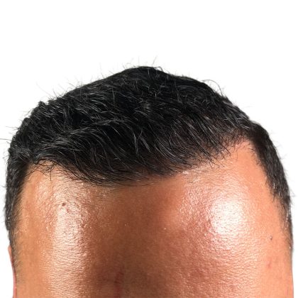 Hair Transplants Before & After Patient #3578