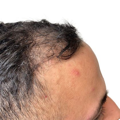 Hair Transplants Before & After Patient #3578