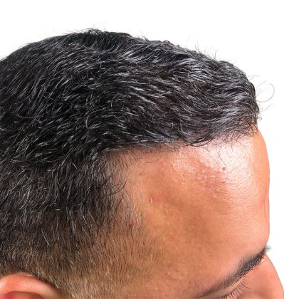 Hair Transplants Before & After Patient #3578
