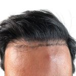 Hair Transplants Before & After Patient #3579