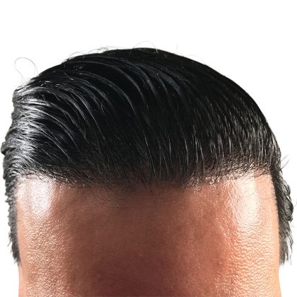 Hair Transplants Before & After Patient #3579