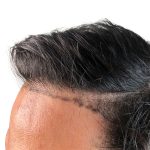 Hair Transplants Before & After Patient #3579