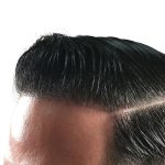 Hair Transplants Before & After Patient #3579