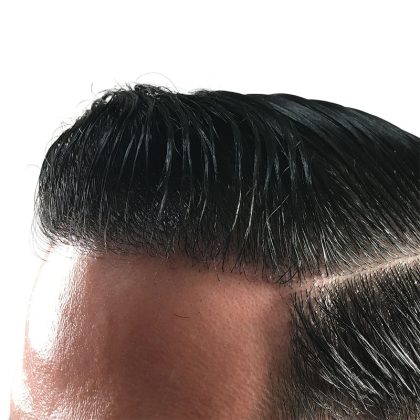 Hair Transplants Before & After Patient #3579