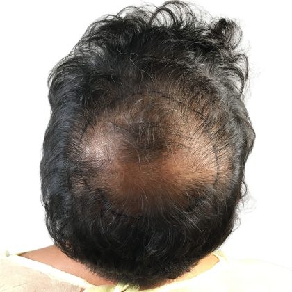 Hair Transplants Before & After Patient #3580