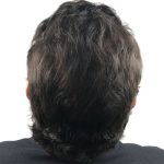 Hair Transplants Before & After Patient #3580