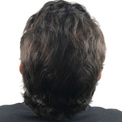 Hair Transplants Before & After Patient #3580