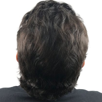 Hair Transplants Before & After Patient #3580