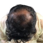 Hair Transplants Before & After Patient #3580