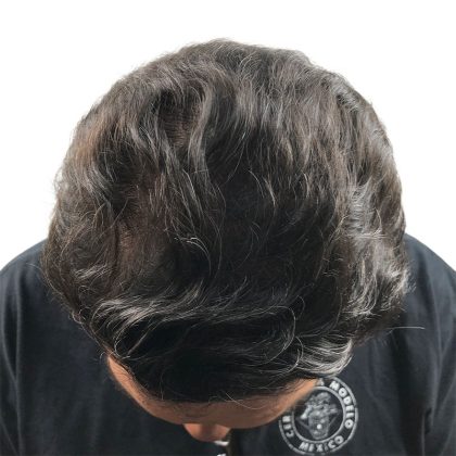 Hair Transplants Before & After Patient #3580