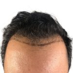 Hair Transplants Before & After Patient #3581