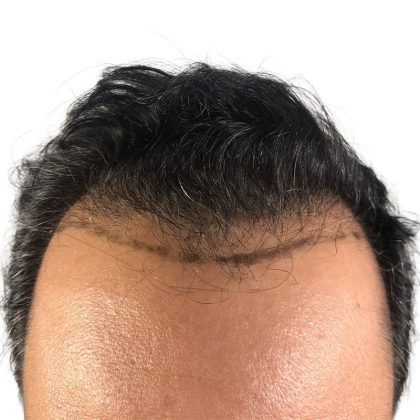 Hair Transplants Before & After Patient #3581
