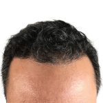 Hair Transplants Before & After Patient #3581