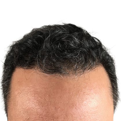 Hair Transplants Before & After Patient #3581