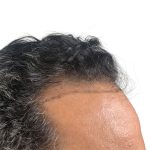 Hair Transplants Before & After Patient #3581