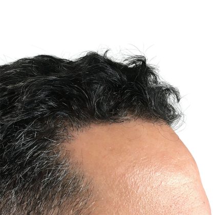 Hair Transplants Before & After Patient #3581