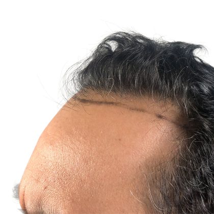 Hair Transplants Before & After Patient #3581