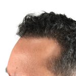 Hair Transplants Before & After Patient #3581