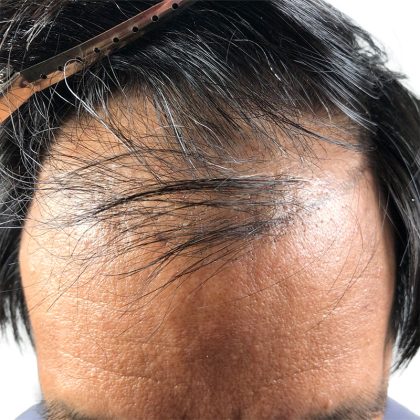 Hair Transplants Before & After Patient #3582