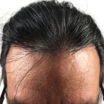 Hair Transplants Before & After Patient #3582