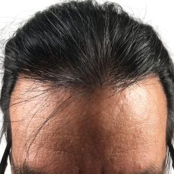 Hair Transplants Before & After Patient #3582