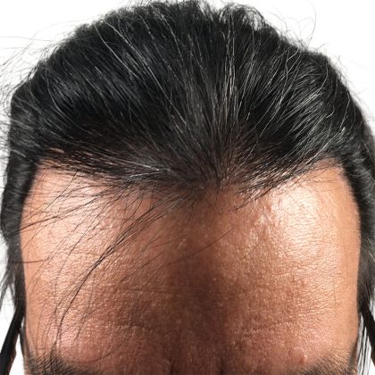 Hair Transplants Before & After Patient #3582