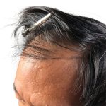 Hair Transplants Before & After Patient #3582