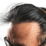 Hair Transplants Before & After Patient #3582
