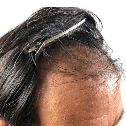 Hair Transplants Before & After Patient #3582