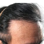 Hair Transplants Before & After Patient #3582