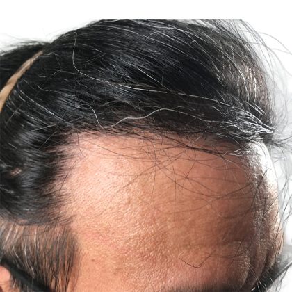 Hair Transplants Before & After Patient #3582