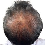 Hair Transplants Before & After Patient #3607
