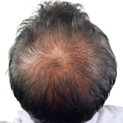 Hair Transplants Before & After Patient #3607