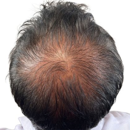 Hair Transplants Before & After Patient #3607